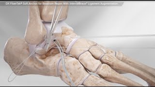 DX FiberTak® Soft Anchor for Brostrom Repair With InternalBrace™ Ligament Augmentation [upl. by Rogovy]