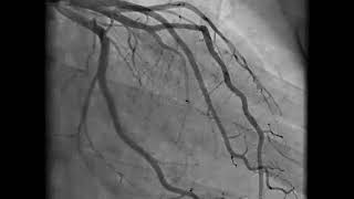 Coronary Angiography  NEJM [upl. by Vocaay]