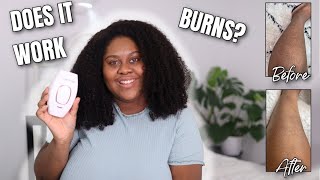 LASER HAIR REMOVAL ON DARK SKIN 4 Weeks Review  RoseSkinCo [upl. by Tneciv]