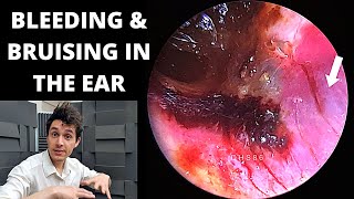 Ear Disorders Pt1 Middle Ear Infection Symptoms amp Otitis Media Causes  Ruptured Eardrum Treatment [upl. by Demah937]