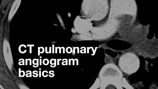 Pulmonary CT Angiogram Basics [upl. by Ibba]