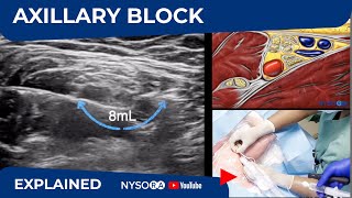 Ultrasound Guided Axillary Brachial Plexus Block NYSORA Regional Anesthesia [upl. by Kristianson]