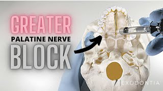 GREATER PALATINE NERVE BLOCK  OnlineExodontiacom [upl. by Ydak]