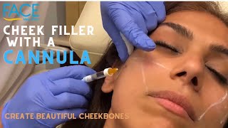 Cheek Filler With Cannula Technique For Cosmetic Injections [upl. by Leakim951]