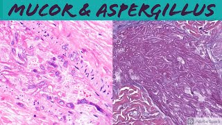 Mucormycosis amp Aspergillosis Angioinvasive Fungal Infection [upl. by Ajroj]