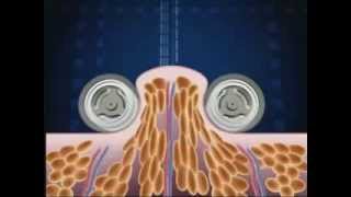 How Endermologie® works lipomassage [upl. by Anawyt]