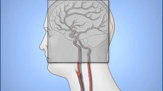 Coronary Angiogram Procedure [upl. by Ardys]