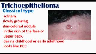 Trichoepithelioma [upl. by Ayotna475]