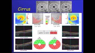 how to read an OCT report of glaucoma [upl. by Parhe]