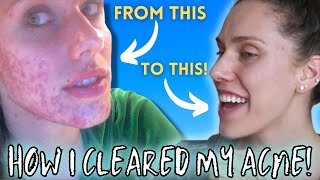 HOW I CLEARED MY ACNE  Chronic Cystic Digestive Hormonal [upl. by Leraj]