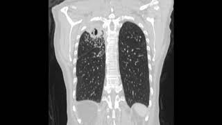 Diagnosis and treatment of chronic pulmonary aspergillosis [upl. by Ahsekam]