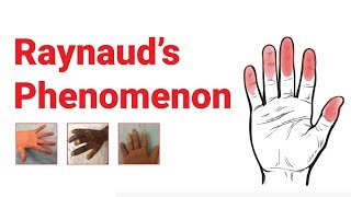 Raynaud’s Phenomenon  What You Should Know  Johns Hopkins Medicine [upl. by Callan]