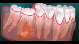 Abcès endodontique dentaire kyste [upl. by Thirzi]