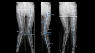 knee pain treatment  Genicular artery embolization on DD News [upl. by Hunfredo913]