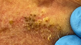 Extremely Clogged Pores Extracted  Contour Dermatology [upl. by Grayson524]