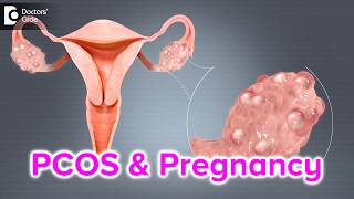 What happens if I have PCOS and I get pregnant  Dr Bala R [upl. by Nnylrefinnej]