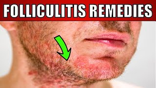 How to treat Folliculitis fungal acne head bumps HOME REMEDIES amp TREATMENT [upl. by Ylatan382]