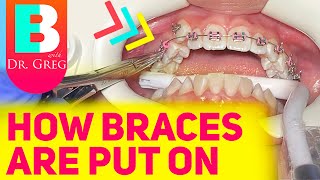 Getting Braces 101  Putting Braces On [upl. by Crystal]