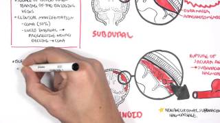 Intracranial Haemorrhage Types signs and symptoms [upl. by Noynek]