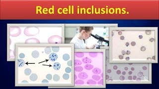 Red cell inclusionsNormoblastRedcellinclusionsSideroticgranulesMalarialparasites [upl. by Leno]