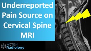 Cervical Spine Facet Pain on MRI [upl. by Atiner]