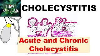 CHOLECYSTITIS Acute and Chronic Pathology and Complications [upl. by Clerk199]