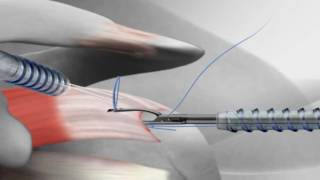 Rotator Cuff Repair with Arthrex® SutureBridge™ [upl. by Annairt]