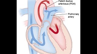 Patent Ductus Arteriosus [upl. by Capello]