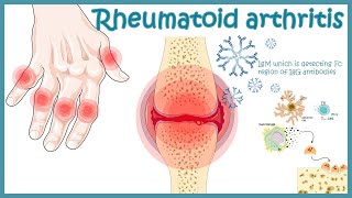 Rheumatoid arthritis causes and early warning signs [upl. by Nahtanoj]