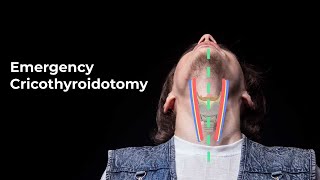 Performing an Emergent Cricothyroidotomy  MEDZCOOL [upl. by Giffer]