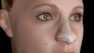 Bulbous Large Nasal Tip Nose Job Rhinoplasty [upl. by Modie45]