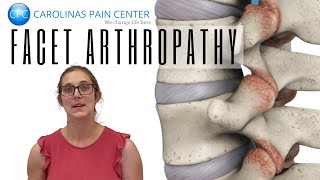 Natalie Explains Facet Arthropathy [upl. by Novyaj487]