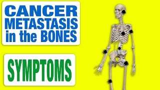 Cancer Metastasis in the Bones  All Symptoms [upl. by Cuthburt]