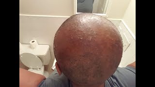 How To Cure Scalp Inflammation Bumps and Blisters  CCCA AlopeciaFolliculitis [upl. by Theola]