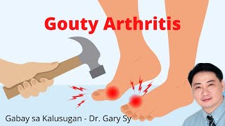 Gouty Arthritis  Dr Gary Sy [upl. by Alejandrina]