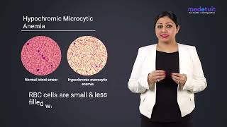 Hypochromic Microcytic Anemia [upl. by Pattison]