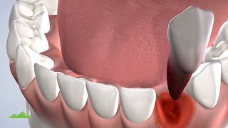 Painless and Easiest method for tooth extraction [upl. by Meter486]