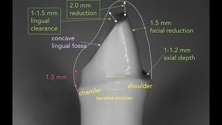 Anterior PFM Preparation  Dr Richard Stevenson [upl. by Trimble]