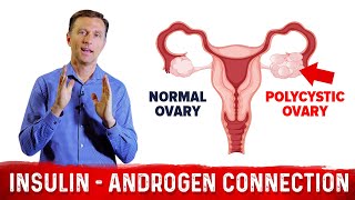 Why Does Insulin Cause PCOS Polycystic Ovary Syndrome – DrBerg [upl. by Dranyl]