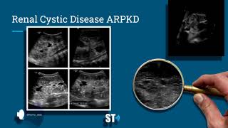 Renal Cysts Ultrasound [upl. by Leopoldine462]