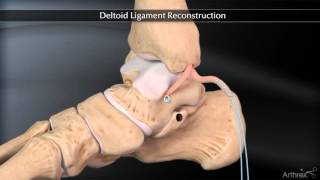 Deltoid Ligament Reconstruction [upl. by Erle]