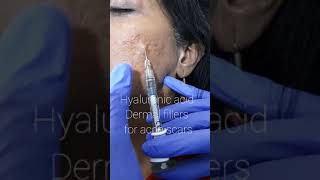 Hyaluronic filler injections for acne scars [upl. by Olli]