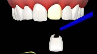 Como o dentista faz uma faceta de porcelana nos dentes [upl. by Chura869]