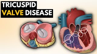 Pulmonary Atresia and Ventricular Septal Defect and Truncus Arteriosus Lan Nguyen MD [upl. by Madson554]