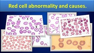 Red cell abnormality and causes [upl. by Yuria]