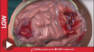 Basic Facts about Traumatic Brain Injury [upl. by Hadeehuat]