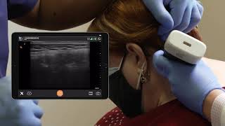 Scanning Technique Occipital Nerve Block [upl. by Riamu]