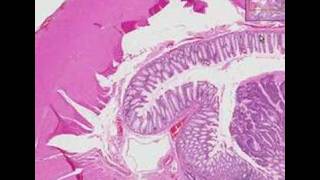 Histopathology Colon Adenocarcinoma [upl. by Fraser]