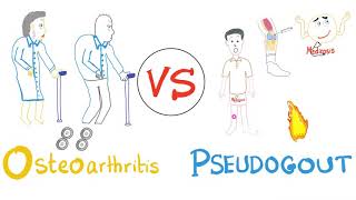 Pseudogout VS Osteoarthritis  Rheumatology Series [upl. by Eiram]