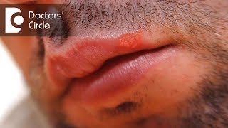 What can cause a lip blister and its management  Dr Sachith Abraham [upl. by Ahsel845]